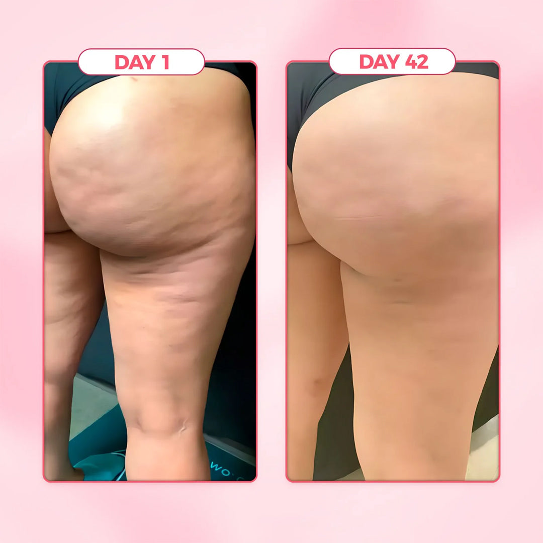 ViralLush™ Cellulite Relief Kit
