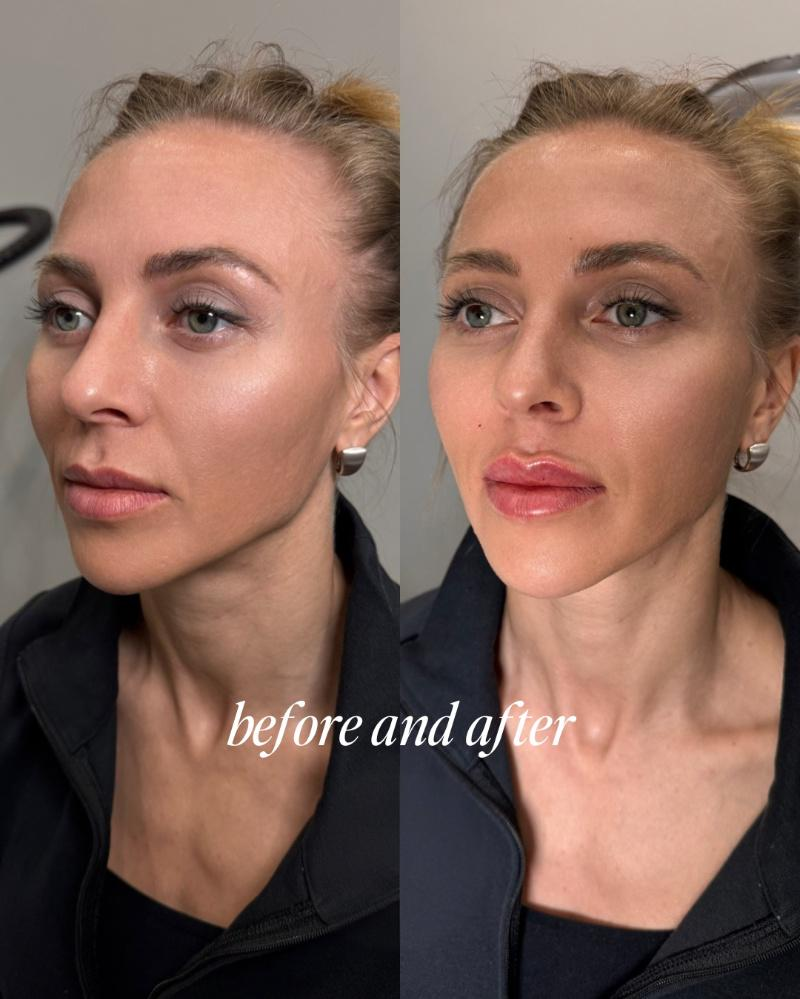 V Lip Plumper gloss lips