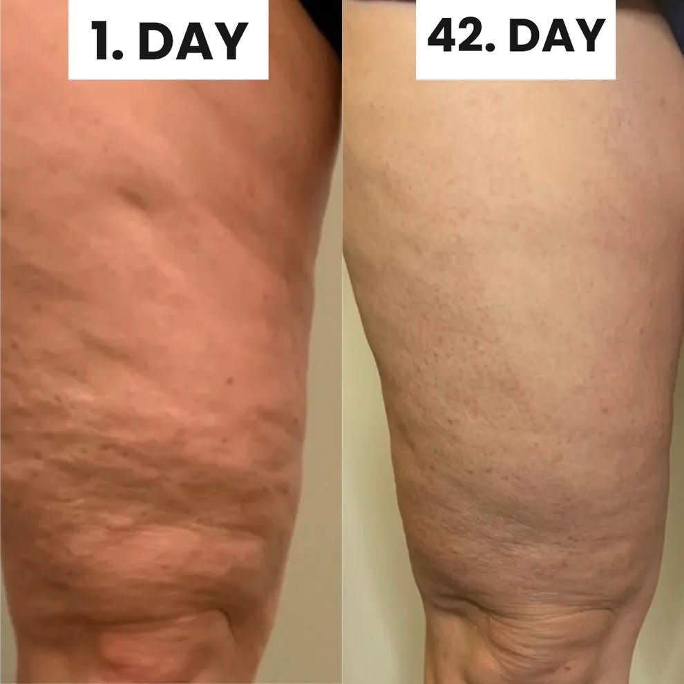 ViralLush™ Cellulite Relief Kit