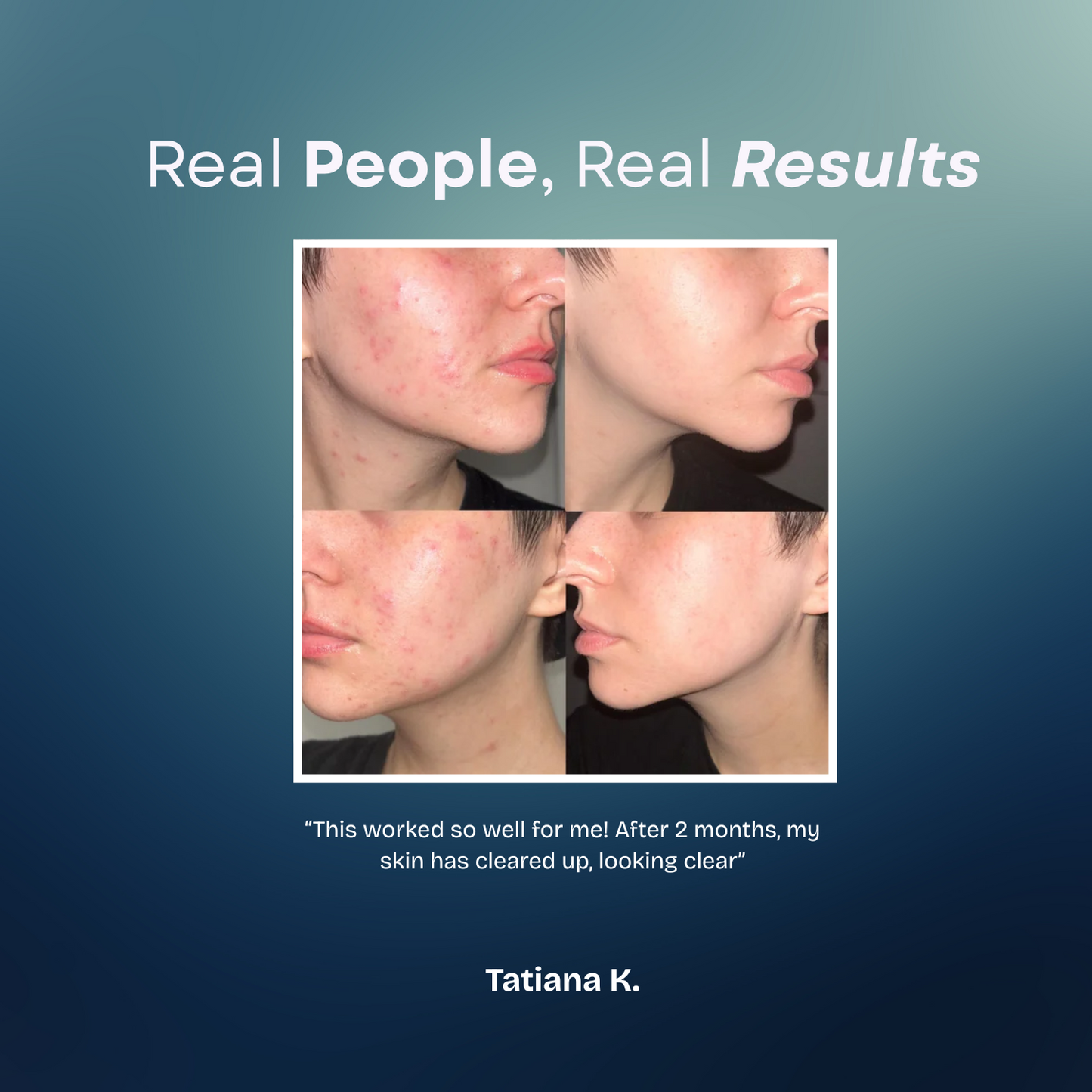 Acne Creamy Foam Facial Wash
