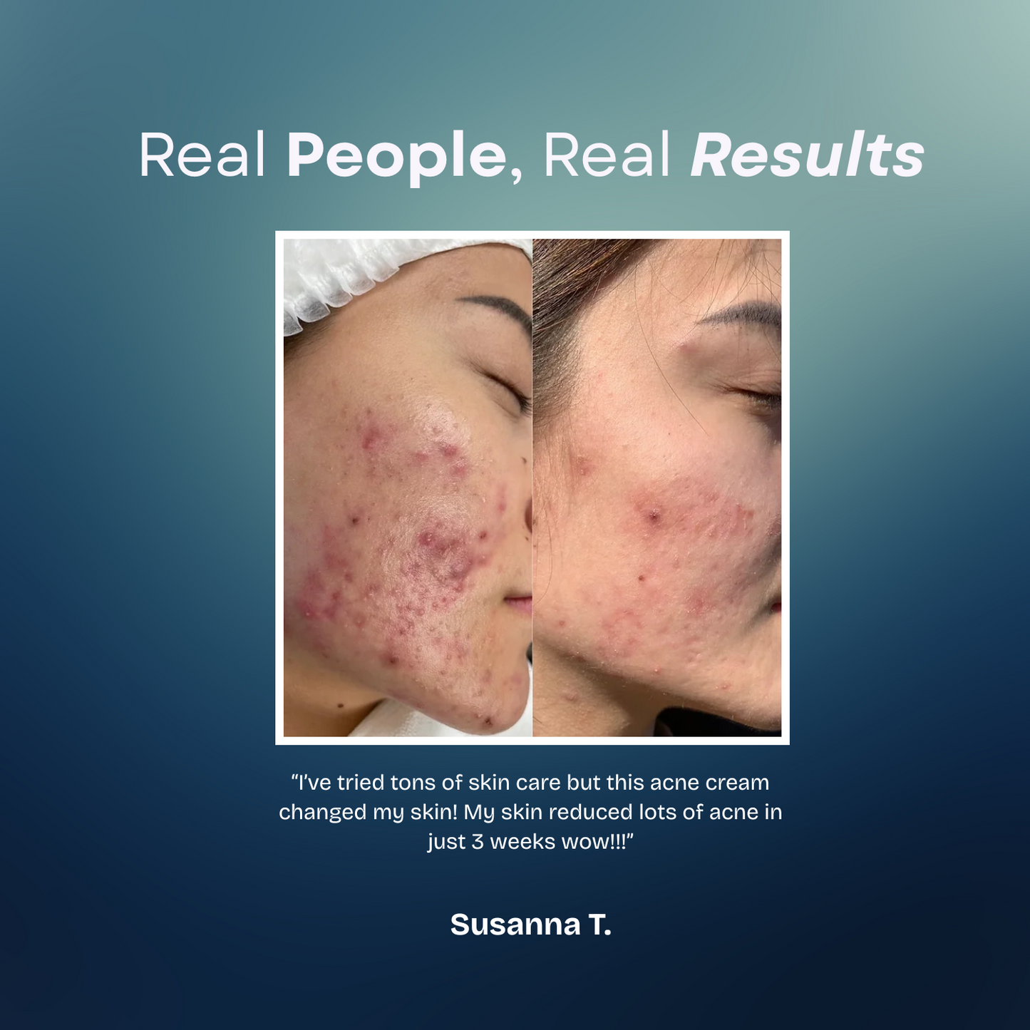 Acne Creamy Foam Facial Wash
