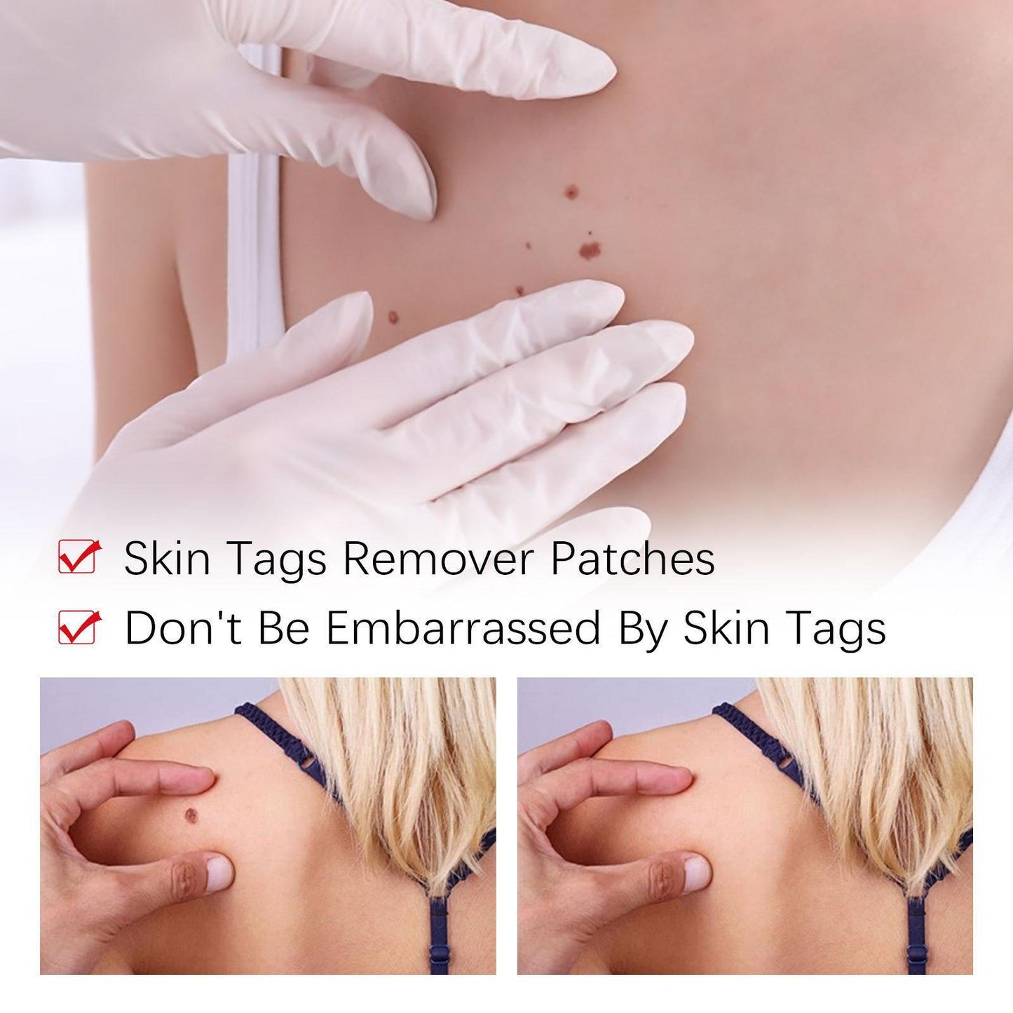 Tags & Moles Remover