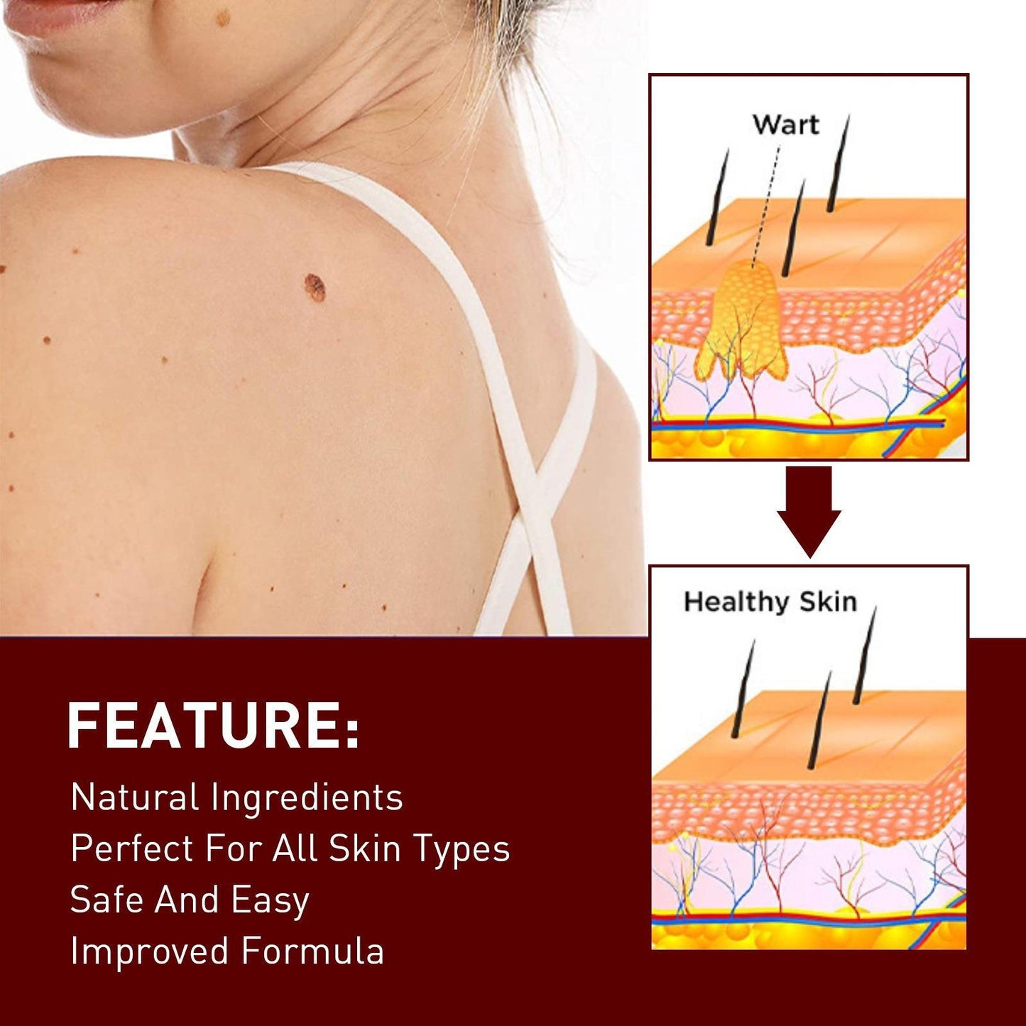 Tags & Moles Remover