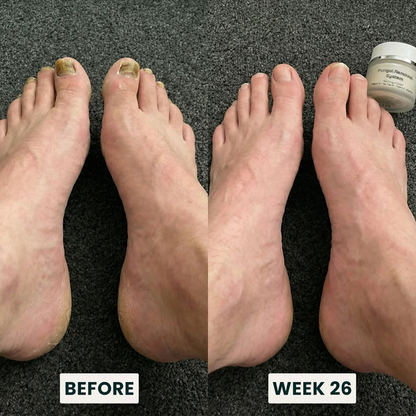 Fungal Removal System