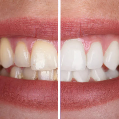 Better Together Bundle:The smart solution against yellow teeth