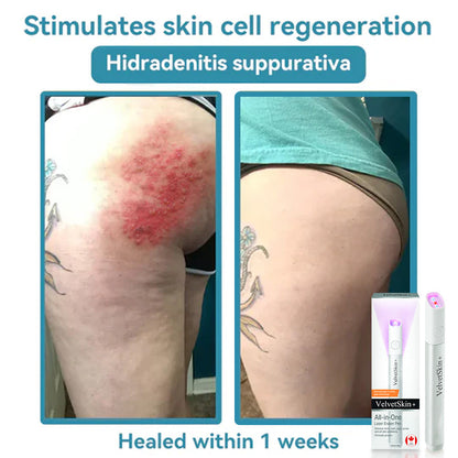 All-in-One CO₂ Laser Eraser Pen | Removes Moles, Warts, Skin Flaws & Pigmentation