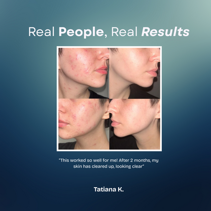 Acne Creamy Foam Facial Wash