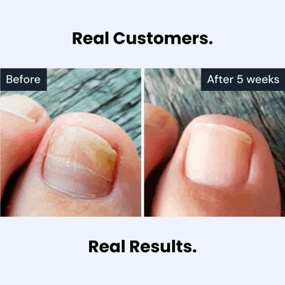 ViralLush™ Antifungal Pen