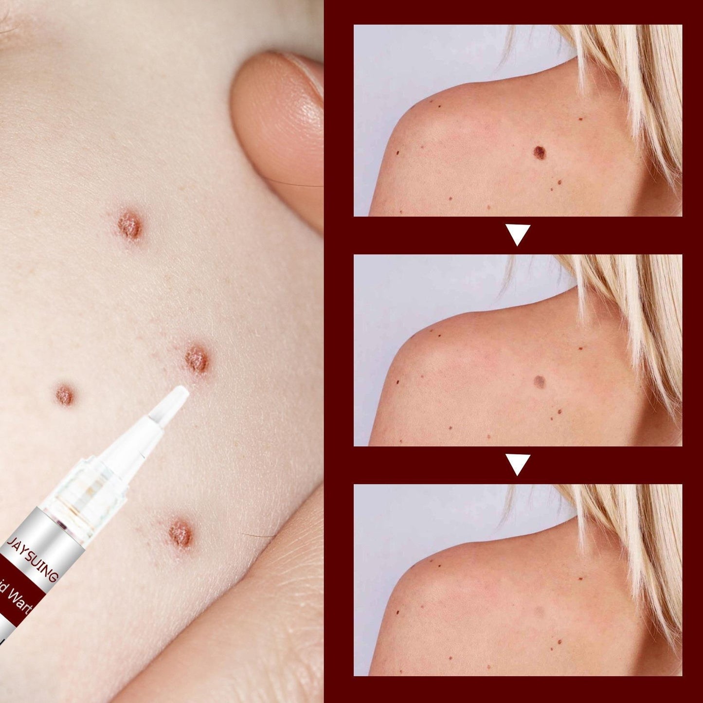 Tags & Moles Remover