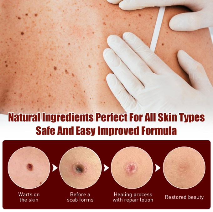 Tags & Moles Remover